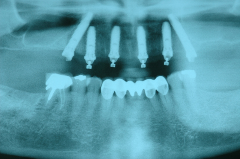 implant03-3