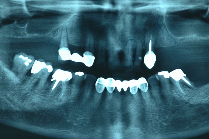 implant3-2